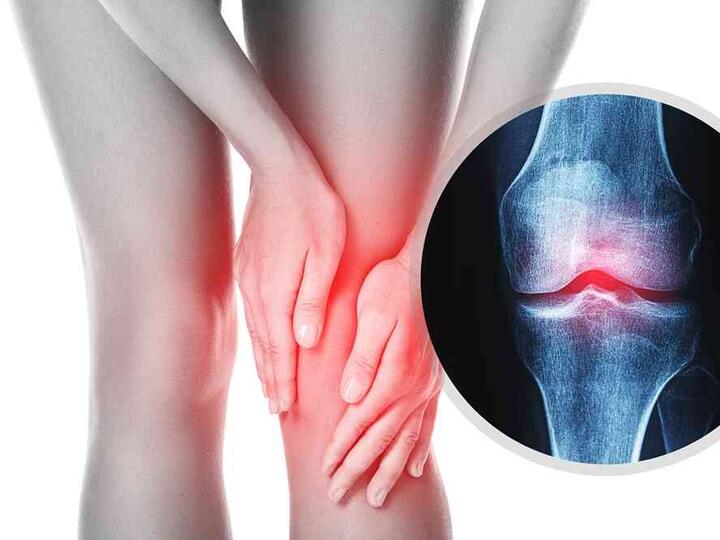 Cum să scapi de artroză