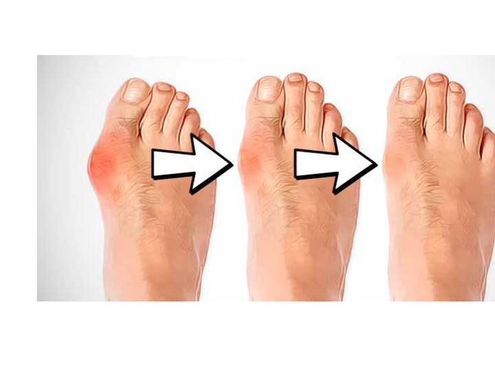 Boala Hallux Valgus - bunion