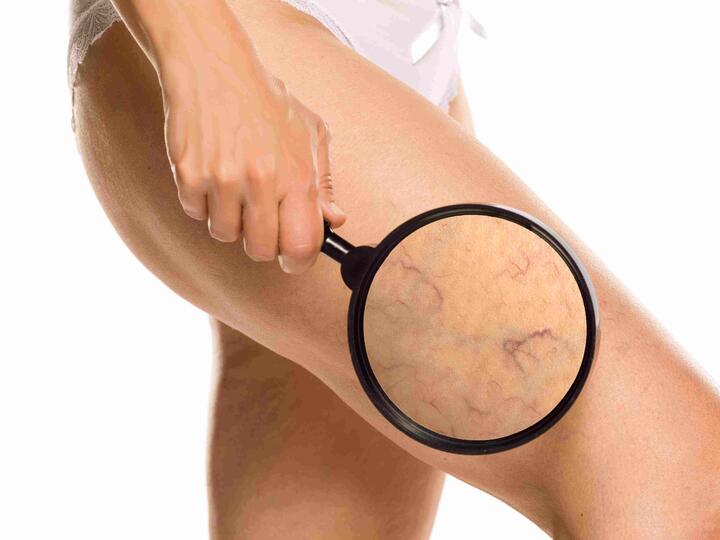 Varice - apariție, prevenire și tratament.